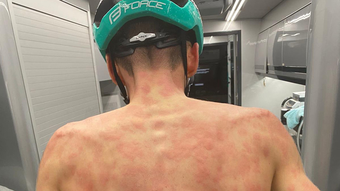 FOTOS: Una súbita granizada castiga a un grupo de ciclistas en plena carrera y deja dolorosas marcas en sus espaldas