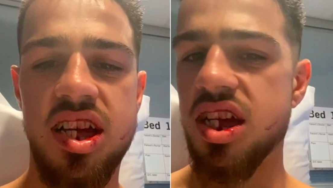 "Así es el boxeo": la terrible lesión de un luchador después de pelear cinco asaltos con la mandíbula rota (VIDEO)