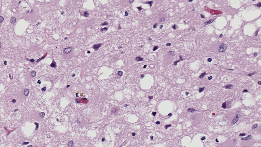 Crece la incidencia de una infección cerebral incurable provocada por priones