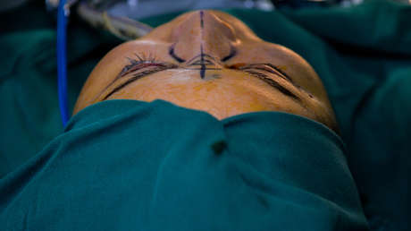 Una joven se somete a unas inyecciones faciales y termina con media cara paralizada