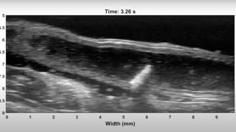 VIDEO: Un microrrobot creado para procedimientos médicos da volteretas en el colon de un animal durante su primera prueba
