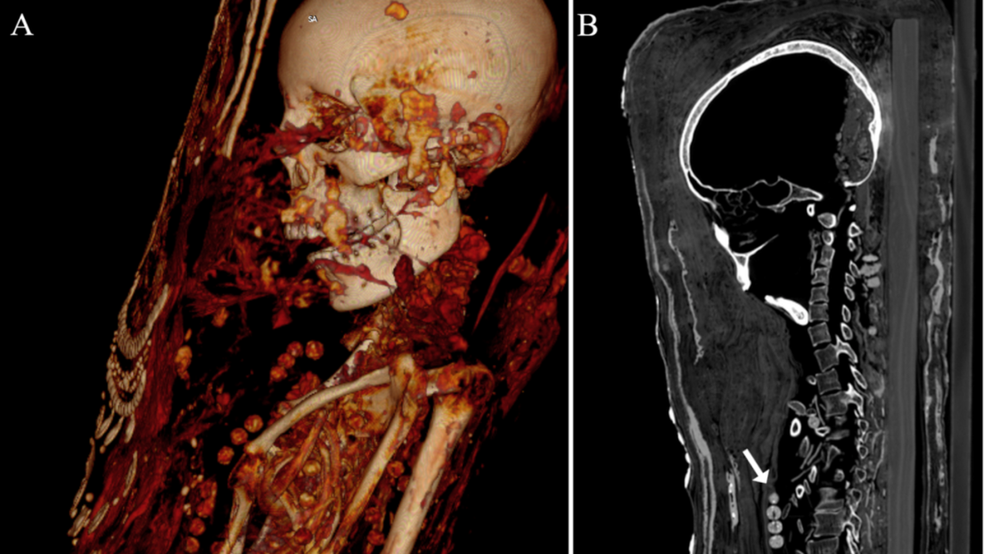 Descubren Una Momia Egipcia Que Aún Conserva El Cerebro Y Otros órganos ...
