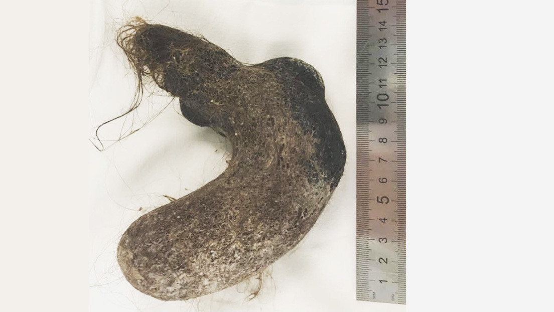 FOTO: Cirujanos extraen una bola de pelos del tamaño de una bota del estómago de una niña de 12 años