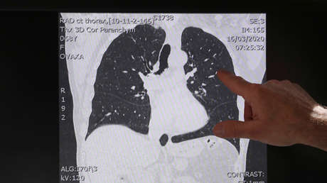 Crean mini pulmones en laboratorio y los infectan con coronavirus para entender mejor cómo ataca a las células