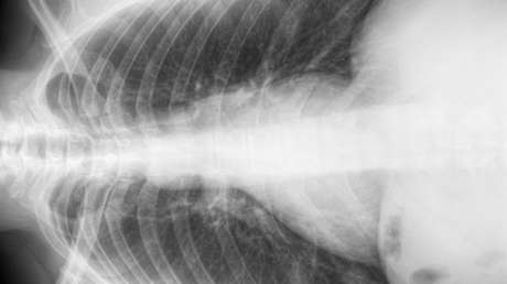 Regala un riñón a su madre por su cumpleaños, pero lo acaba recibiendo un desconocido