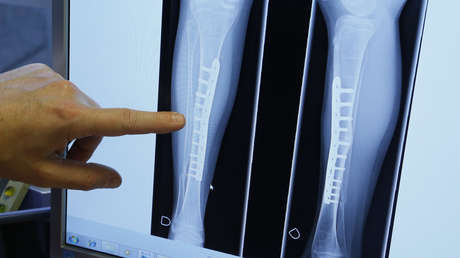 Los veganos son un 43% más vulnerables a las fracturas de huesos que los consumidores de carne