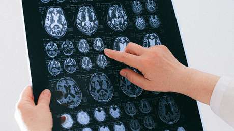 Descubren que un parásito que se encuentra en la carne poco cocinada podría estar relacionado con un raro cáncer cerebral