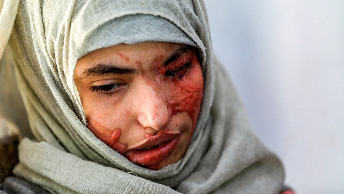 Una joven yemení es obligada a casarse a los 12 años y posteriormente su marido le desfigura el rostro con ácido