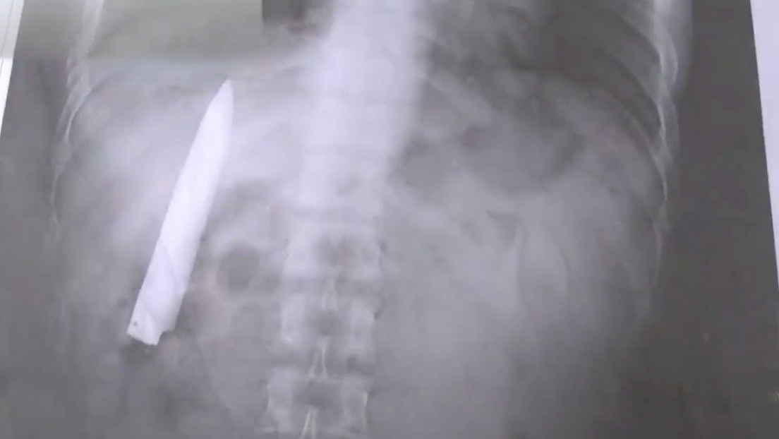 Un hombre descubre una hoja de cuchillo dentro de su torso 14 meses después de ser apuñalado