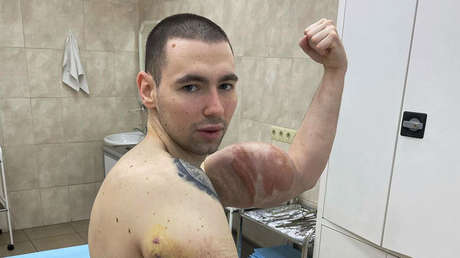 El 'Hulk ruso' muestra sus tríceps tras una segunda cirugía para extraer la mezcla casera que se inyectó para aumentar su volumen muscular