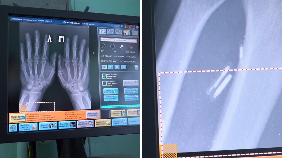 Un médico ruso se implanta 5 microchips en las manos para hacer su vida "más fácil" (VIDEO)