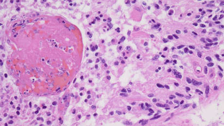 Científicos imprimen en 3D el primer tumor cerebral maligno activo del mundo (VIDEO)