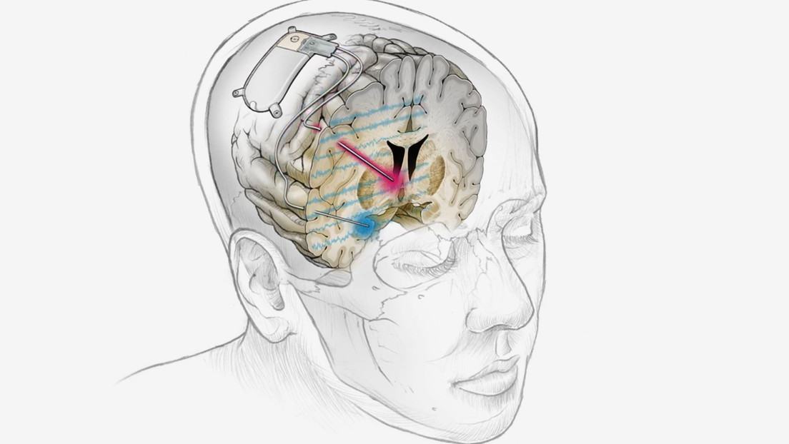 Implantan un dispositivo cerebral a una paciente que permite tratar por primera vez con éxito la depresión resistente a medicación y terapia