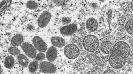 Madrid comienza este lunes a realizar PCR en cinco hospitales para diagnosticar la viruela del mono