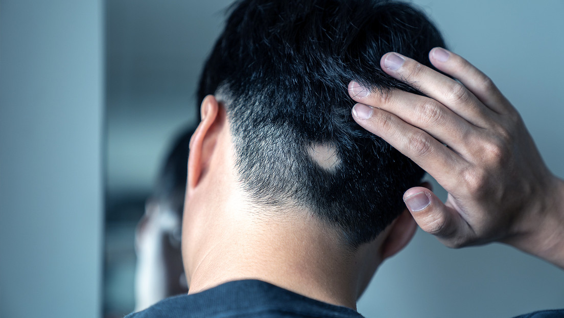 Aprueban en EE.UU. el primer tratamiento sistémico de la alopecia severa en adultos, trastorno que provoca la caída de cabello