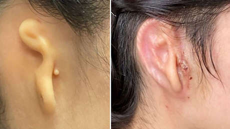 Una mexicana recibe un implante de oído fabricado en 3D con sus propias células en un primer ensayo clínico en humanos