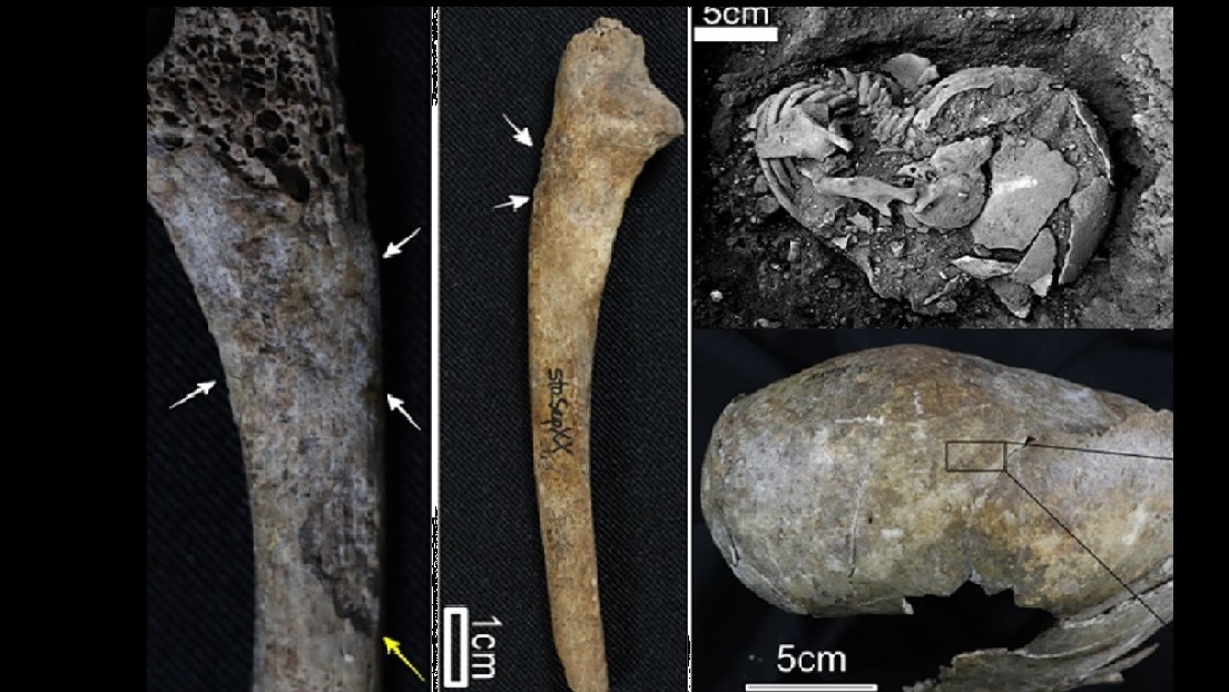Descubren en un menor enterrado hace 9.400 años la evidencia más antigua de sífilis en América