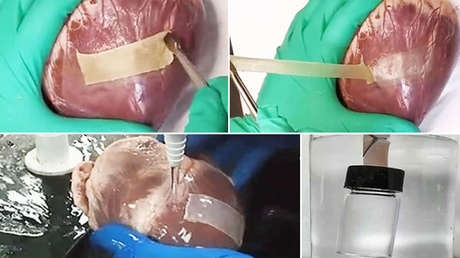 Un nuevo parche de hidrogel doble cara podría reparar eficientemente corazones infartados