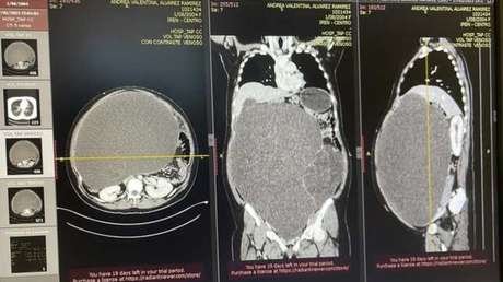 Extirpan un tumor de 20 kilos y un metro de altura a una joven peruana