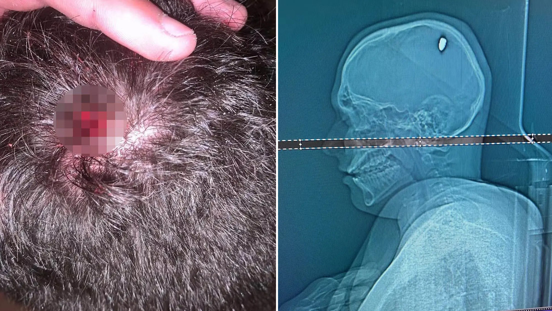 Recibe un disparo en la cabeza en una fiesta y solo descubre que tenía una bala en el cerebro 4 días después