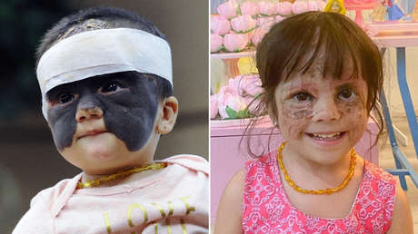 Vuelve a Rusia la niña de EE.UU. que nació con 'máscara de Batman' para seguir el tratamiento