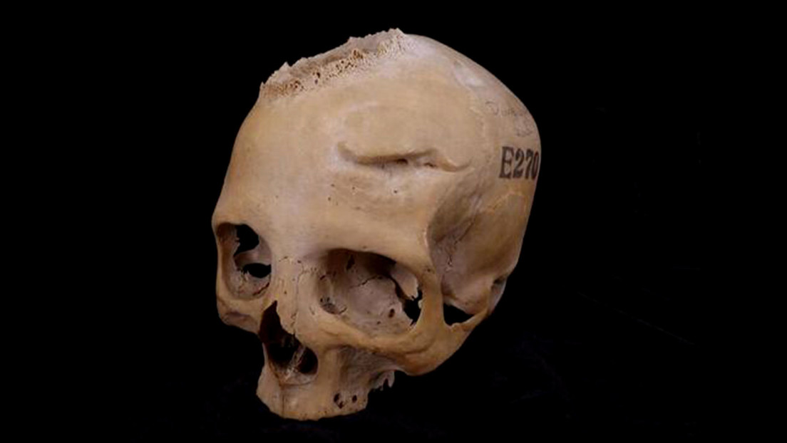"Un hito en la historia de la medicina": Documentan una cirugía de hace 4.000 años para tratar el cáncer
