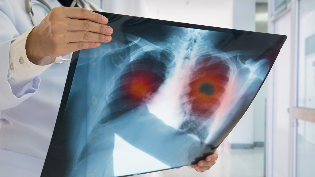 Descubren que la comida chatarra puede elevar el riesgo de sufrir este tipo de cáncer