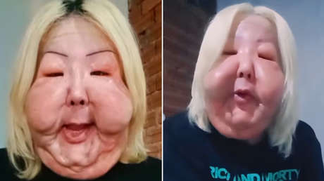 El procedimiento clandestino que desfiguró la cara de una 'influencer' brasileña