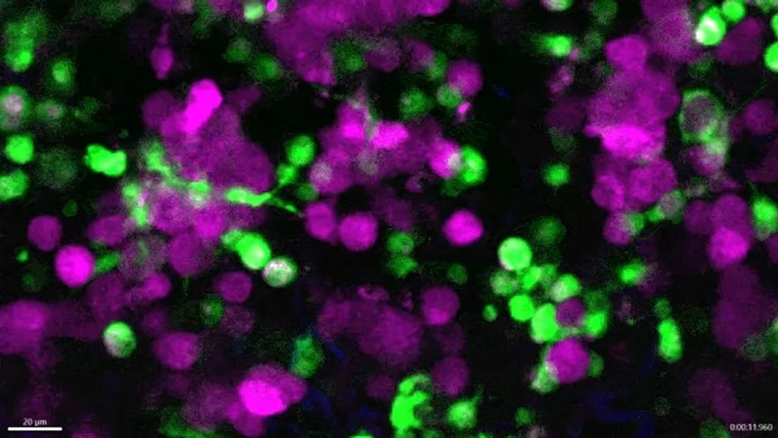 Graban en tiempo real células del sistema inmune devorando un cáncer de piel