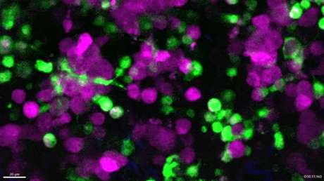 Graban en tiempo real células del sistema inmune devorando un cáncer de piel