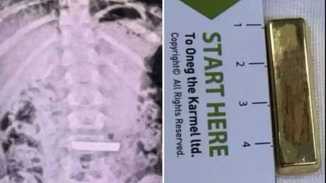 Hospitalizan a una niña de 5 años tras tragarse un lingote de oro
