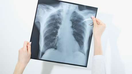 La ciencia encuentra una posible forma de frenar el cáncer de pulmón antes de que aparezca