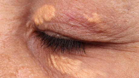 Lo que unas manchas alrededor de los ojos podrían decir sobre tu salud