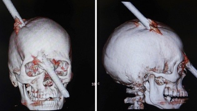 Brasil: un obrero con el cráneo atravesado por una barra sale ileso del quirófano