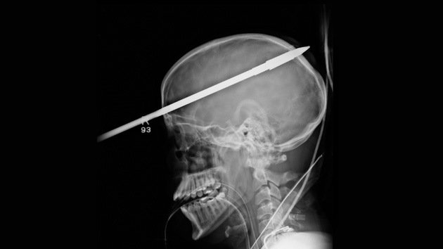 VIDEO: Médicos de Miami extraen un arpón atravesado en el cráneo de un jóven