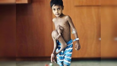 Un 'niño araña' vuelve a disfrutar de  la vida