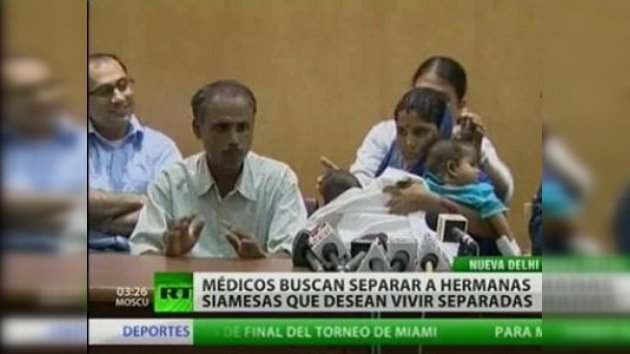 Cirujanos discuten separación de siamesas indias