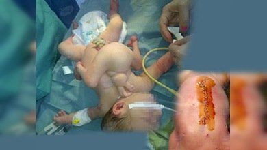 Nace niña con cuatro brazos y cuatro piernas en Azerbaiyán