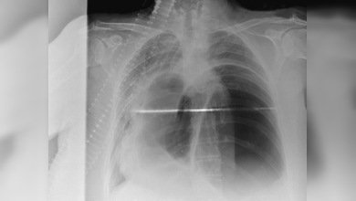 Un chino vivió casi 30 años con un palillo para comer dentro de su cuerpo