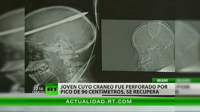 Joven cuyo cráneo fue perforado por pico de 90 centímetro, se recupera