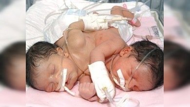 Nacen siamesas en Honduras que comparten casi todos los órganos vitales