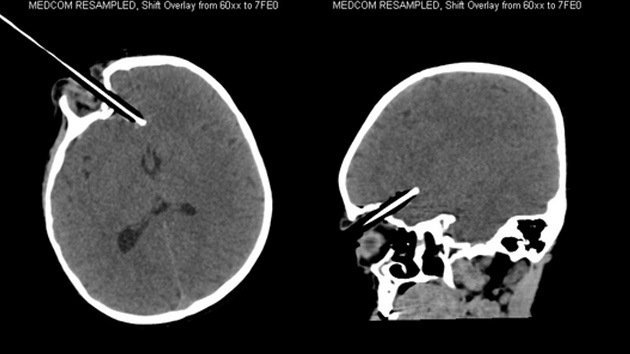 Una niña de 2 años se recupera tras clavarse un lápiz en el cerebro