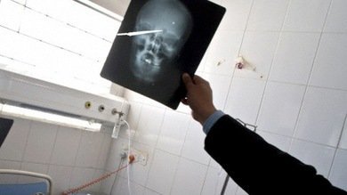 Sobrevive un hombre con un cuchillo de 8 centímetros clavado en su cabeza