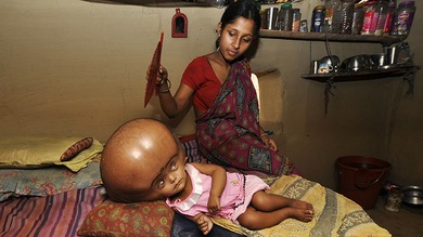 Niña india con la cabeza hinchada, a la espera de un milagro