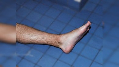 Una estadounidense, acusada del robo de una pierna mutilada en un accidente