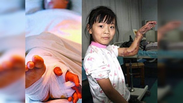 Unos cirujanos chinos salvaron el brazo de una niña al coserlo a su pierna