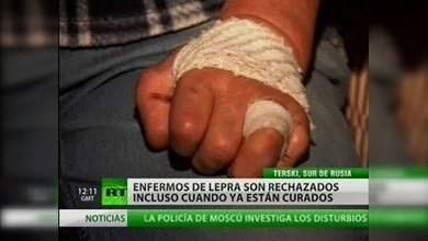 Leprosos en Rusia: víctimas de la ignorancia de la gente