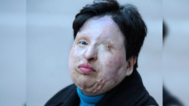 La mujer cegada con acido sulfúrico en Irán no aplicará la ley del talión