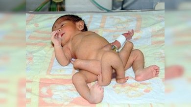 Nace un bebé con seis piernas en Pakistán