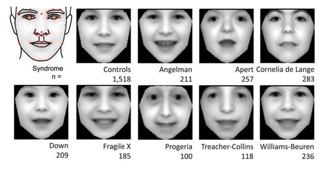 Crean un software capaz de diagnosticar trastornos genéticos por una foto